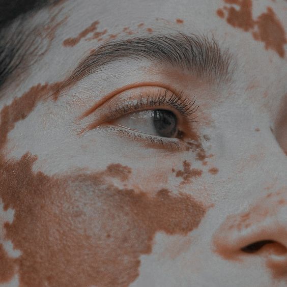 Ruxolitinib në trajtimin e vitiligos: Një avancim i ri në menaxhimin klinik të sëmundjes