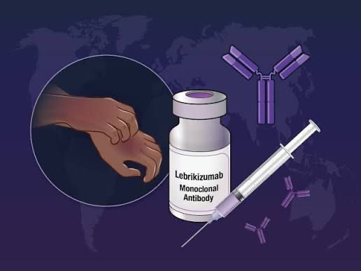Lebrikizumab në trajtimin e dermatitit atopik të fëmijëve me shkallë mesatare dhe të rëndë: rishikim i trialit ADorable1